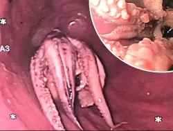 Pria Ini Muntah-muntah, Susah Menelan, Ternyata Ada Gurita di Tenggorokannya