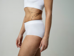 7 Cara Ampuh Mengatasi Stretch Mark pada Remaja, dari Bahan Alami hingga Perawatan Medis