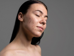 Jangan Panik Saat Breakout! Begini Cara Merawat Wajah dengan Tepat