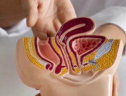 Permintaan Vasektomi di Kota Bekasi Meningkat